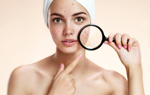 Acne: trattamento pelli impure